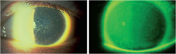 Figure 13. Solution-induced corneal staining from the use of a preserved saline for application.