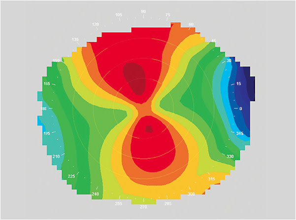 Figure 1. Clinically significant limbus-to-limbus corneal astigmatism.