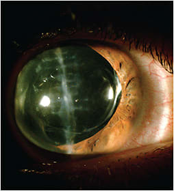 Figure 1. The cataract was replaced with an intraocular implant.