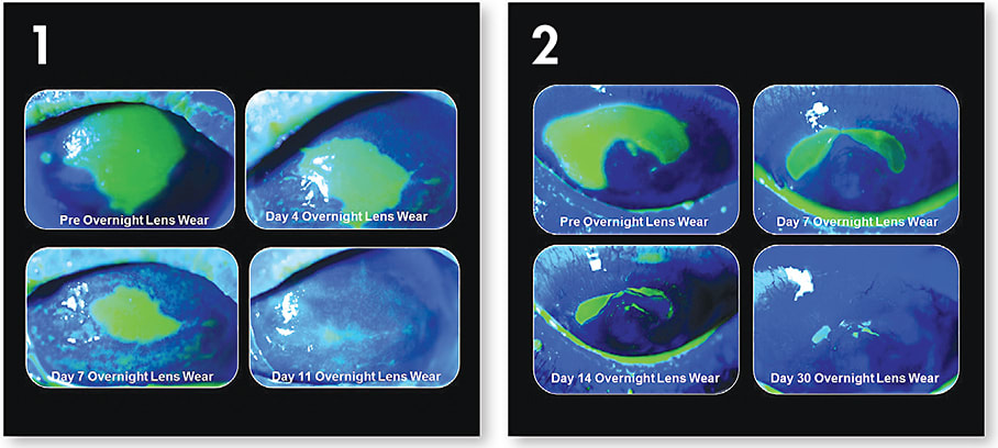 Figures 1 and 2. Two examples of a patient who has a persistent epithelial defect pre- and post-treatment with the prolonged/overnight wearing of a scleral lens.