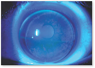 Figure 3. Non-rotational multifocal lenses resemble multifocal spectacles, with a distance optic at the top and a near optic at the bottom.