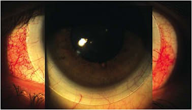 Figure 4. A scleral lens that is compressing in the horizontal meridian only. This lens will need to be made with a toric haptic and with a flatter landing zone in the horizontal meridian only.