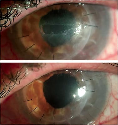 Figure 8. Resolution of a long-standing persistent epithelial defect after extended therapeutic scleral lens wear. (Top) Pre-lens wear. (Bottom) 14 days into scleral lens wear.