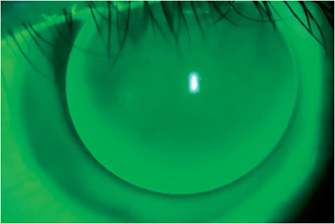Figure 1. Temporally decentered aspheric lens showing alignment fitting pattern. Centration can be achieved by steepening the base curve and/or increasing the diameter.All images courtesy of Kevan Smith, OD