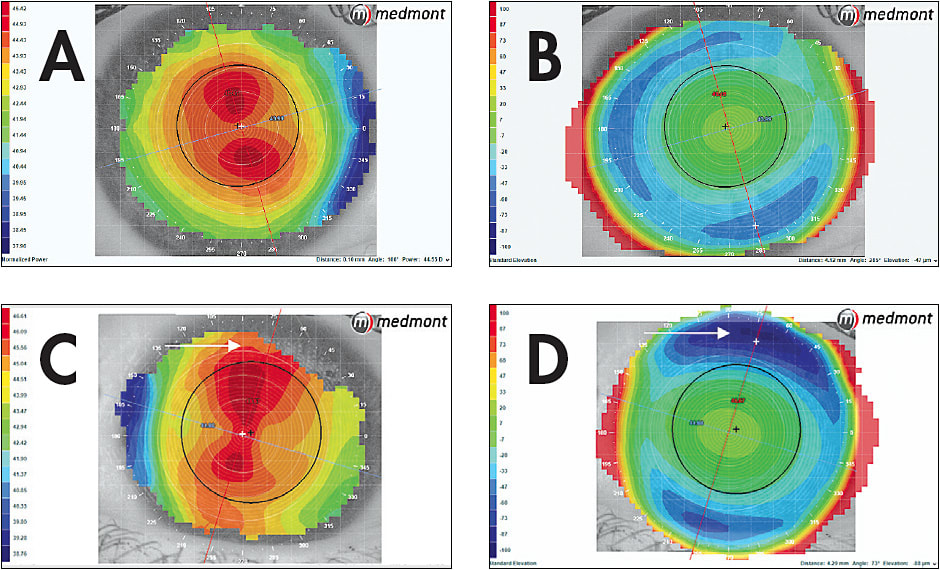 Figure 7. (A) An eye with about 1.50D of with-the-rule apical astigmatism. (B) An elevation difference of 18 microns in a cornea that has apical astigmatism. (C) An eye with about 1.50D of with-the-rule limbus-to-limbus astigmatism. (D) The elevation difference, 47.4 microns, of this cornea is significant, with the vertical/steep meridian being significantly lower.