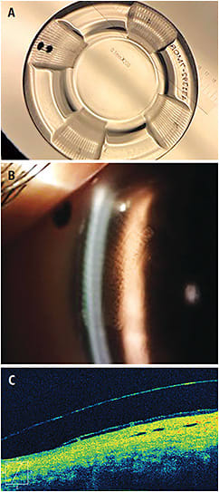 Figure 1. An 18.0mm diameter scleral lens with four milled channels in each major meridian as viewed under magnification (A), anterior segment OCT (B), and slit lamp (C).