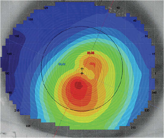 Figure 2. A hybrid lens can be a great option for central and paracentral cones that are well-defined and have an apex within 5mm of pupil center.Photo courtesy of Stephanie Ramdass, OD, MS, MBA.