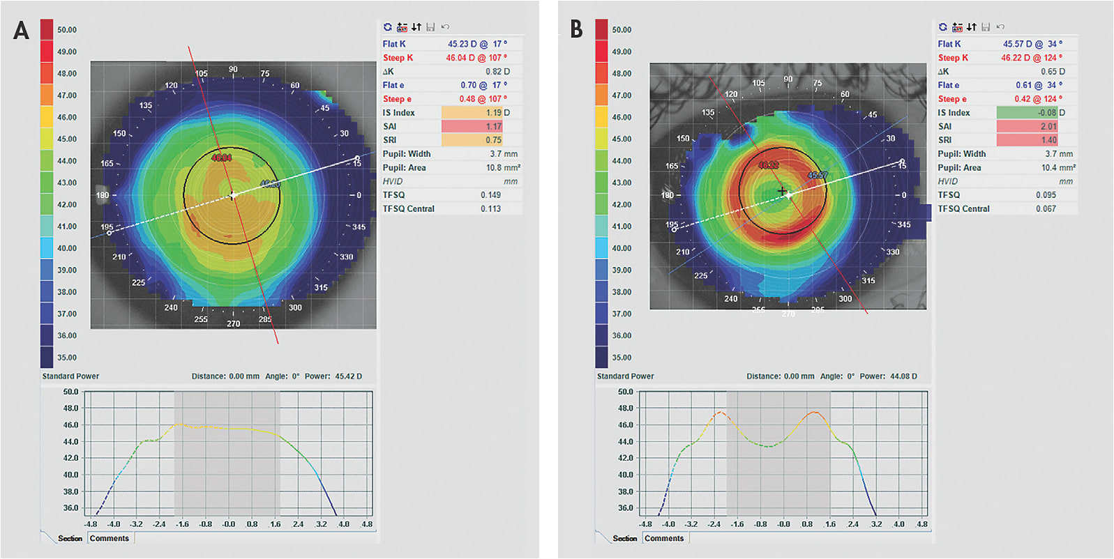 Figure 1. Modern ortho-k lens designs allow for fast and predictable treatment. (A) Topography of a young myopic astigmatic patient before treatment and (B) after 20 minutes of wear.