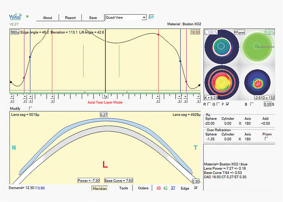 Figure 18. Software design box for Case 4 patient’s left lens.