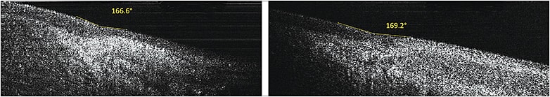 Figure 2. (Left) The nasal corneoscleral junction angle was measured to be 166.6°. (Right) The temporal corneoscleral junction angle was measured to be 169.2°. This small difference may have a profound effect on contact lens behavior on the eye. These images were captured with a custom-built OCT developed at the University of Alabama at Birmingham.