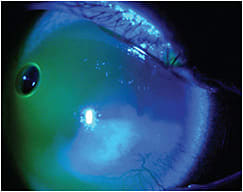 Figure 2. Stage 1 NK can be therapeutically treated with scleral lenses. Photo courtesy of Melanie Frogozo, OD.