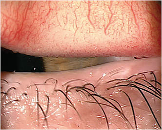 Figure 1. The smaller overall diameter of a corneal GP lens may help reduce the incidence of GPC by avoiding certain areas of the palpebral conjunctiva.