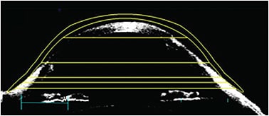 FIGURE 5. An OCT image showing an oblate scleral lens applied on an eye that has advanced keratoconus.