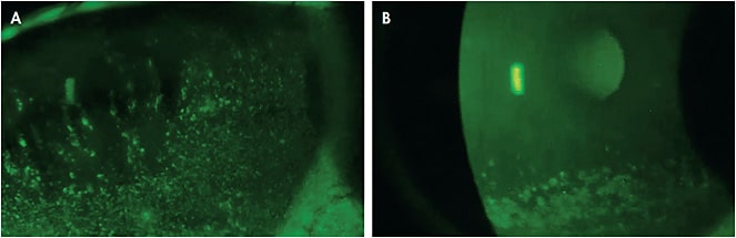 Figure 2. (A) Severely compromised cornea secondary to Sjögren’s keratoconjunctivitis sicca. (B) The same cornea 30 days after successfully being fit with a scleral lens and wearing it for one month.