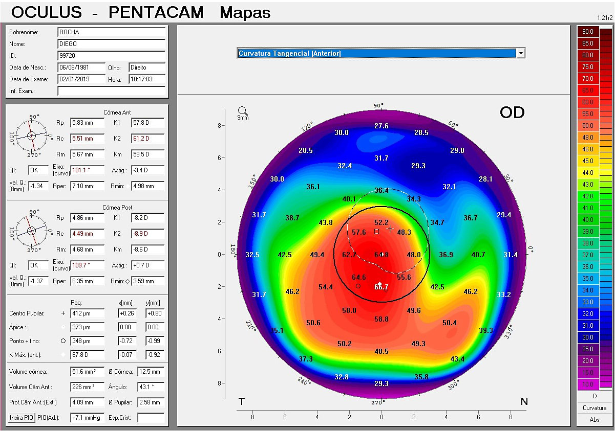 Figure 3. Tangential curvature map OD after three days without GP lens wear.