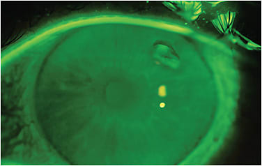 Figure 1. The cornea after improper lens application during a Bell’s phenomenon. The eye rolled upward, and the edge of the lens dug into the corneal epithelium, creating a rolled ridge. There was no epithelial defect.