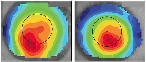 Figure 3. Two corneas that have displaced apexes and a degree of asymmetry that might be suggestive of keratoconus.