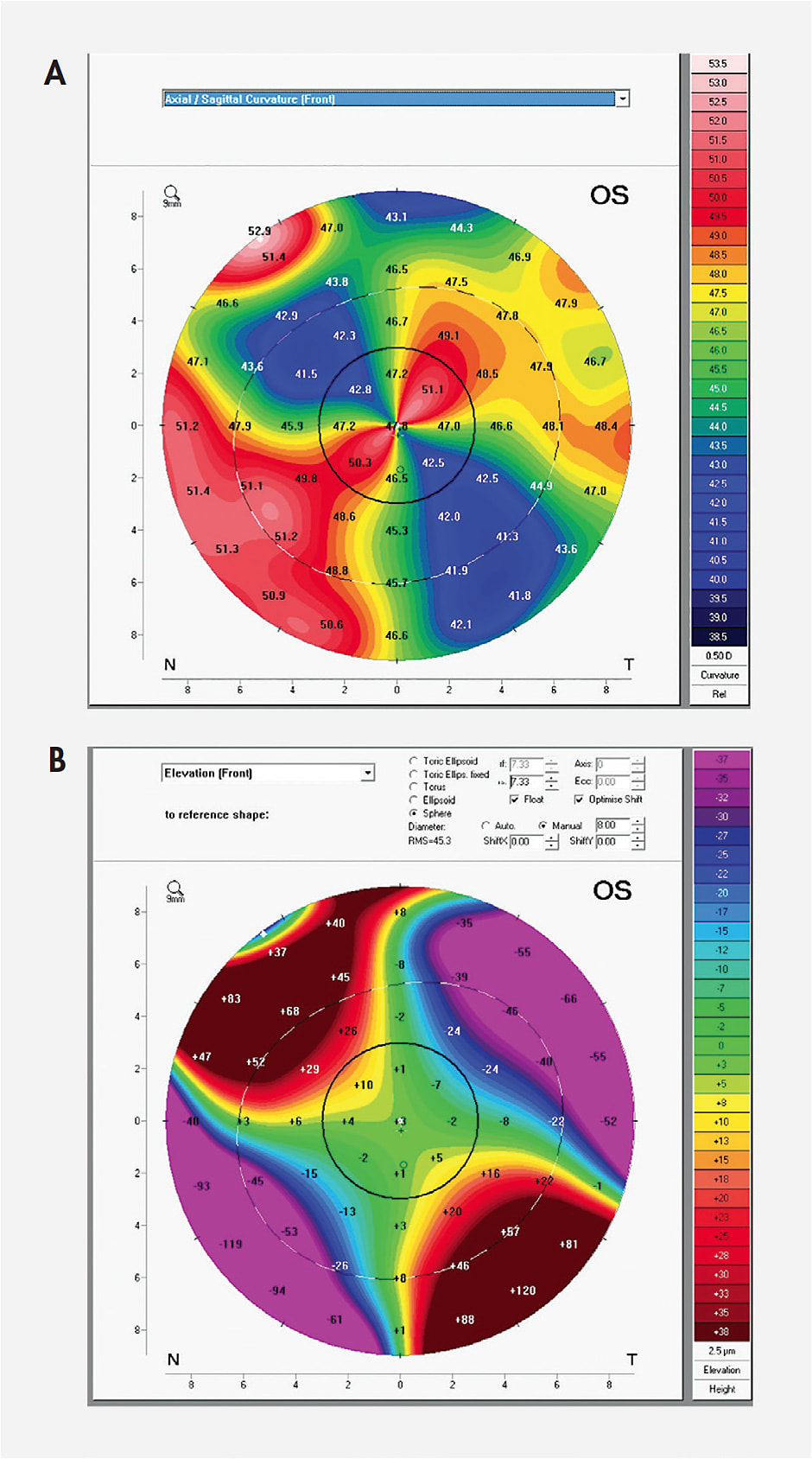 Figure 6. Axial curvature map (A) versus anterior elevation map of post-PK cornea (B). Note that the flat curvature regions are the most elevated regions.