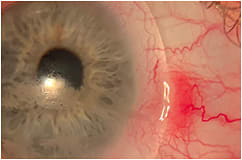 Figure 1. Pingueculitis secondary to scleral lens wear.