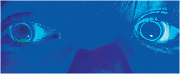 Figure 1. The posterior tear lens behind GP lenses effectively corrects high amounts of corneal astigmatism in children being fitted in contact lenses for myopia management.