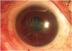 Figure 2. A scleral contact lens that provides improved vision and corneal protection.