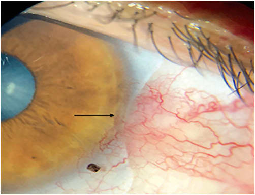 Figure 3. The same lens with a notch that was given more depth and width. Image courtesy of Omar Sámano.