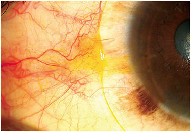 Figure 10. Conjunctival hypertrophy secondary to chronic edge impingement.