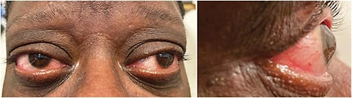 Figure 1. (Left) The patient’s relatively small palpebral aperture size and bulbar hyperemia. (Right) The right eye in profile showing significant corneal ectasia.