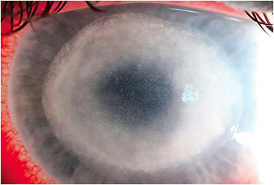Figure 3. This patient presented with a classic ring infiltrate and was diagnosed with advanced Acanthamoeba keratitis caused by showering with soft contact lenses. Photo courtesy of the Francis I. Proctor Foundation/UCSF.