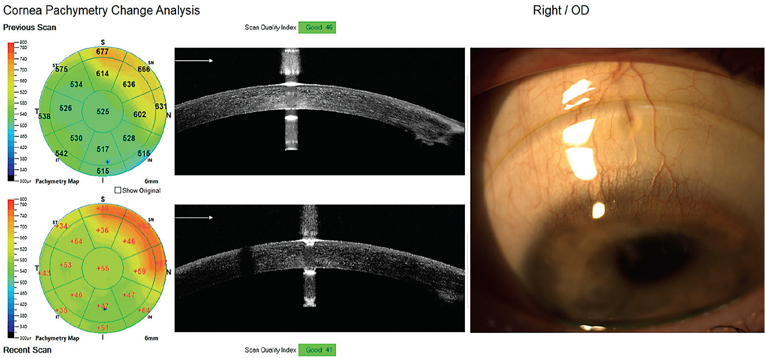 FIGURE 10. Pachymetry shown by OCT showing clinically significant edema induced by one to two hours of scleral lens wear (left). Anterior segment image of the scleral lens on eye. Neovascularization of the cornea is also imaged (right). Image courtesy of Andrea Lasby, OD