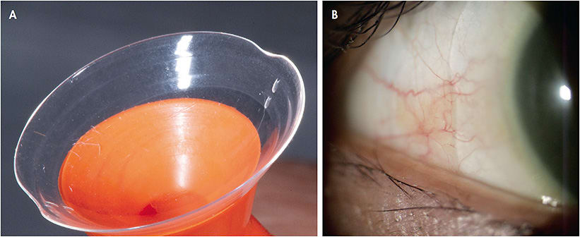 Figure 4. (A) A notched scleral lens, (B) a notched lens on-eye over a pinguecula.