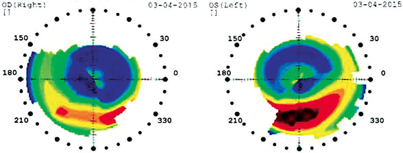 Figure 1. Inferior smile patterns resulting from decentered ortho-k lenses can be corrected by steepening the reverse curve and/or the alignment curve.