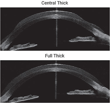 Figure 3. Custom soft lens profiles captured with wide-angle optical coherence tomography (OCT). (Top) The central thick lens has a double slab-off prism design. (Bottom) The full thick lens has the same thickness edge to edge.