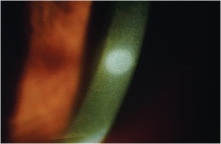 Figure 1. Corneal inflammatory event. Image courtesy of Dr. Loretta Szczotka-Flynn