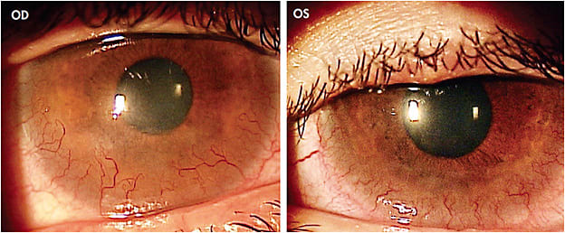 Figure 1. Appearance of the right and left eyes of the patient in Case 1.