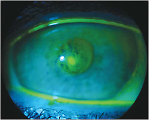 Figure 1. Apical erosion in keratoconus GP fitting.