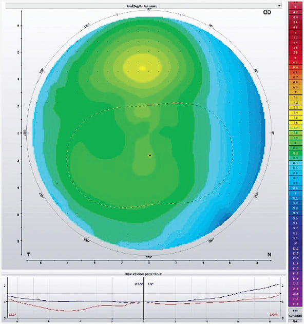 Figure 1. Keratometry values: 41.0 @ 002/42.9 @ 092; refraction: &amp;#x2013;5.00 &amp;#x2013;2.00 x 180. Due to her flat Ks and high refraction, this patient was deemed a poor candidate for orthokeratology.