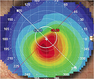 Figure 2B. Topography of the same keratoconus patient.