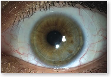 Figure 1. Hybrid lens fit on an eye with a 10.5mm HVID.View video here.