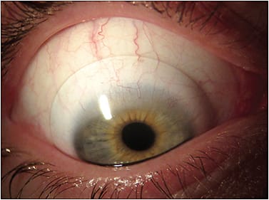 Figure 3. A 15.5mm mini-scleral contact lens to correct high hyperopia.