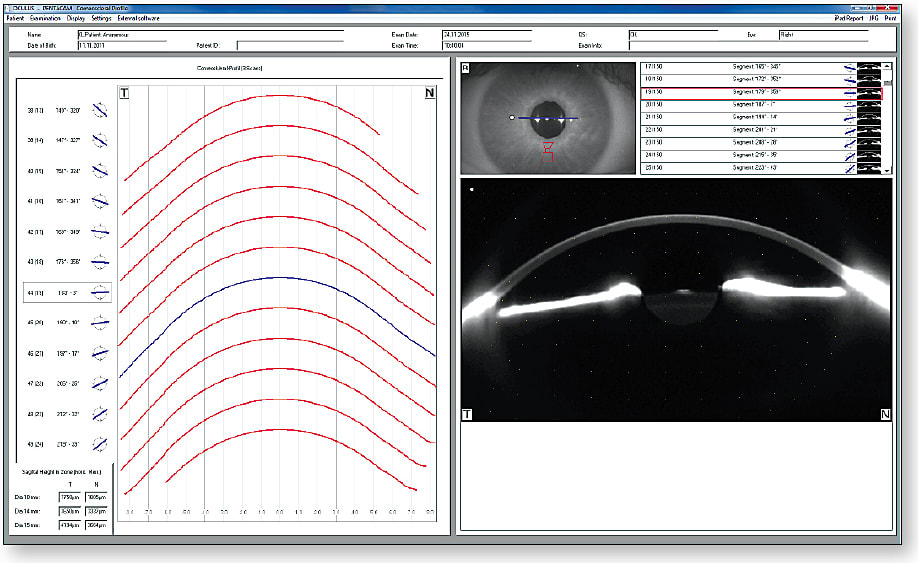 Figure 13. A corneo-scleral profile display on a corneal topographer.