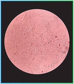 Figure 1A. KOH wet mount preparation showing broad hyaline aseptate hyphae with angle branching.Image courtesy of Tribhuvan University Teaching Hospital, Nepal