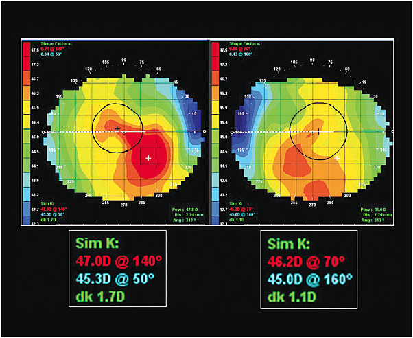 Figure 3. Our patient’s corneal topography; note the asymmetric corneal astigmatism.