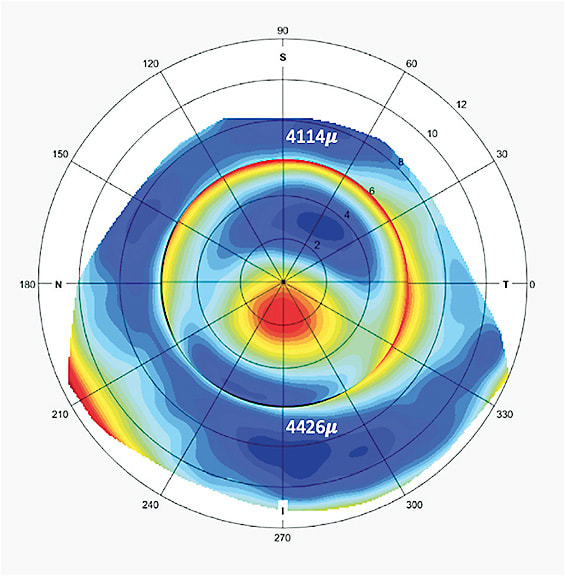 FIGURE 4. A corneal scleral elevation map of a keratoconic eye that has an inferiorly positioned apex with a quadrant-specific effect of scleral sagittal height at a 16mm chord. Figure courtesy of Greg DeNaeyer, OD