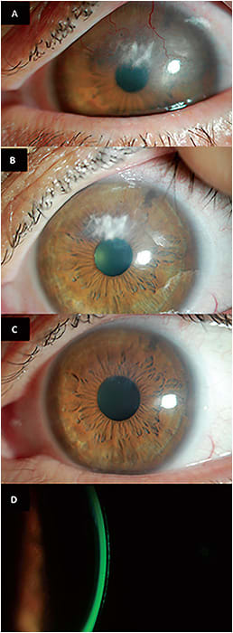 Figure 1. A case showcasing complete corneal remodeling and improvement at the cornea&#x2014;at initial presentation (A); after two months (B); after two years of scleral lens wear (C); and with a central clearance of ~&#x2265;450&#x3BC;m and no signs of clinically significant edema (subjective or objective) (18.5mm scleral lens/material Dk 85) (D). With a center thickness (CT) of 200&#x3BC;m, the Dk/l of the system was ~40, which, based on Kim et al,6 is more than an adequate Dk/l value to prevent clinically significant edema and may explain the dramatic clinical benefits in this case.&#xD;&#xA;Images reprinted with permission from J Ophthalmol Clin Res.17