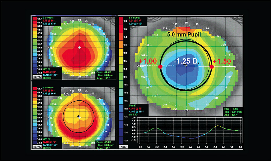 Figure 1. When correcting myopia with ortho-k, the amount of steepening in the periphery is equal to the amount of flattening in the center.