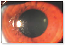 Figure 1. The right eye with a contact lens without the Hydra-PEG coating.View video here