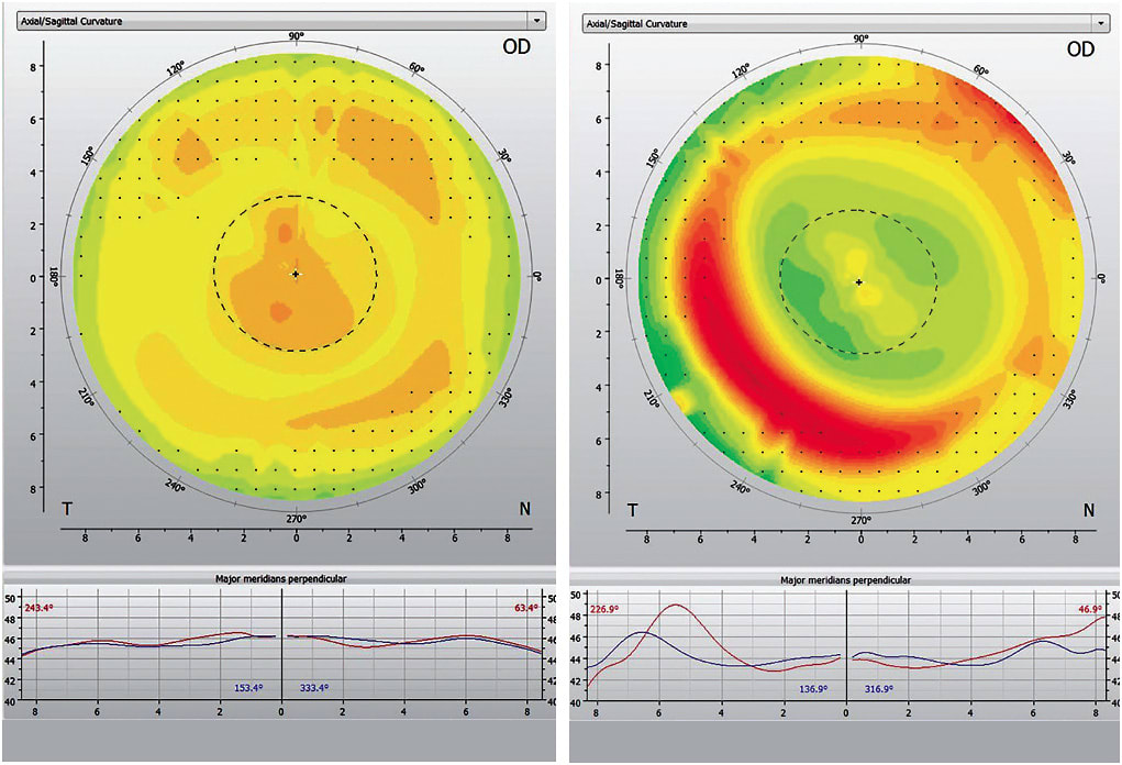 Figure 1. Topography of the same eye using the same ortho-k lens one week apart.