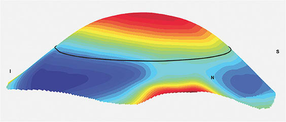 Figure 14. Case 3 patient’s right eye scleral elevation map with scleral toricity and asymmetry.