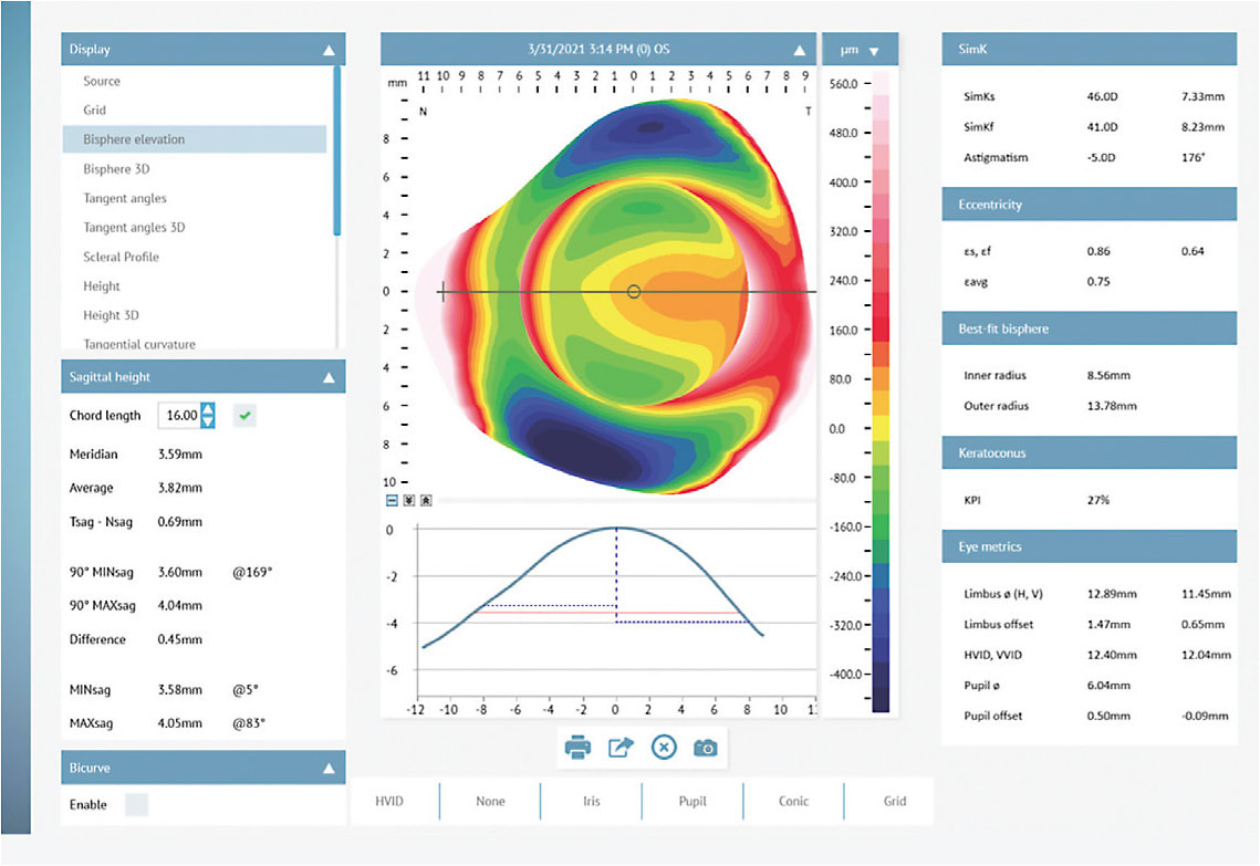 Figure 2. A profilometry map of a highly toric eye. The vertical meridian demonstrates a very steep profile, while the horizontal meridian is much flatter. The sagittal height menu on the left side allows you to evaluate height and toricity at any chosen chord length. The headers on the left provide data about the eye, including keratometric readings, eccentricity, and corneal diameter.